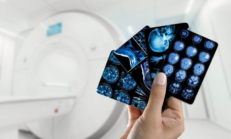 esclerose e direitos previdenciários